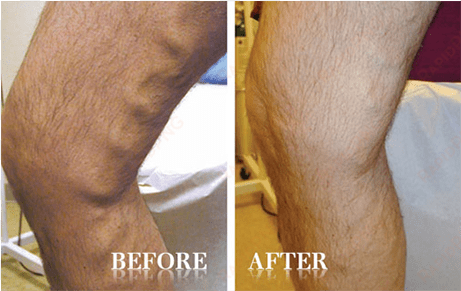 advanced vein & laser center contents gallery vein - horse chestnut varicose veins before and after