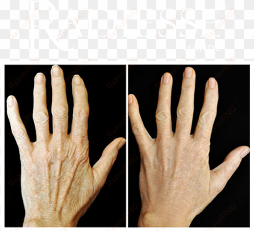 before and after treatment with radiesse® hands - thermage hands before after