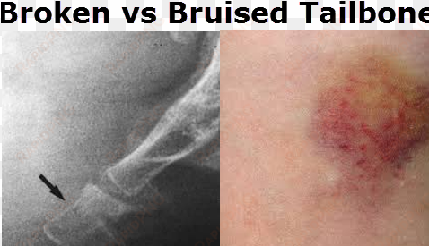 bruised tailbone vs broken tailbone - bruised tailbone