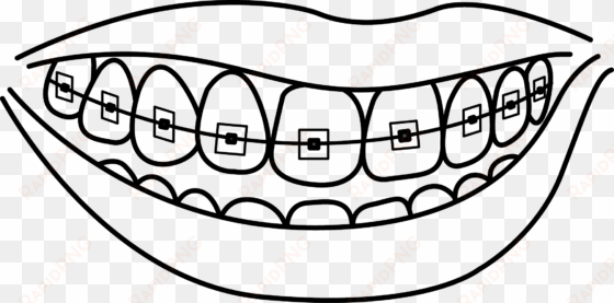 clip transparent download braces at getdrawings com - teeth with braces drawing