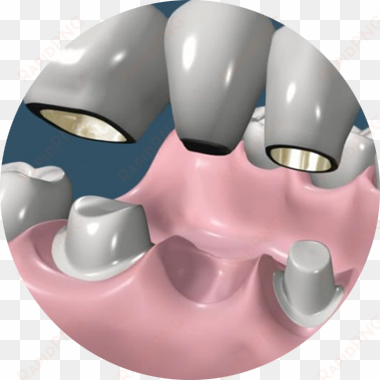 Coronas Y Puentes - Prostodoncia Odontologia transparent png image