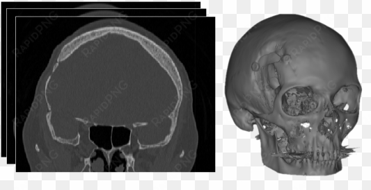 ct-scan segmentation & 3d reconstruction - ct scan transparent