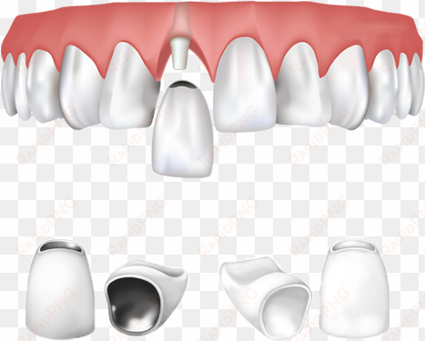 dental crowns types - dental crown png