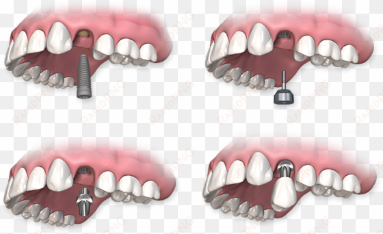 Dental Implants - Implant Healing Cap Abutment transparent png image