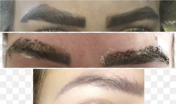 elinimink eyebrow correction - eyebrow laser tattoo removal