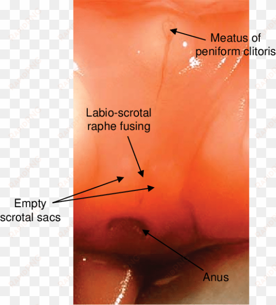 external genital development of a female spotted hyena - clitoris developing