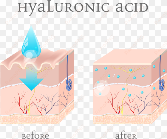 illustration of before and after-effects of hyaluronic - injectable filler
