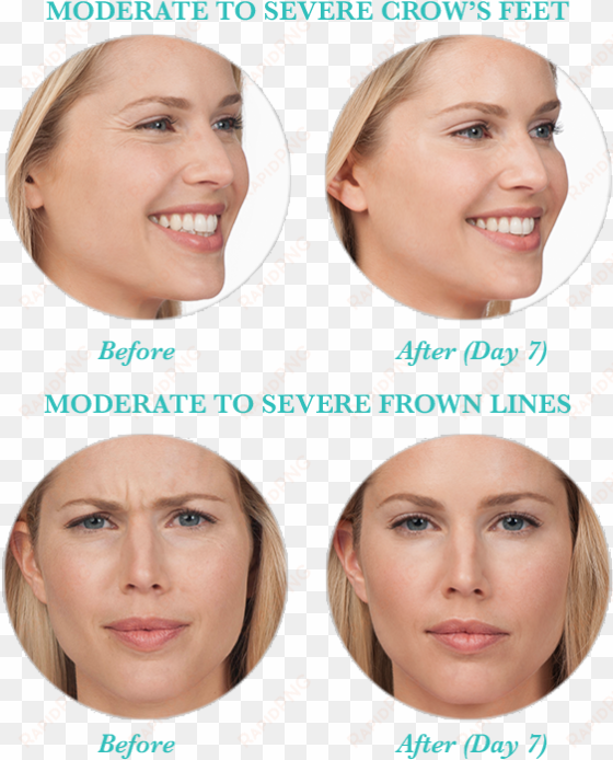 in some cases, botox® can also be used to reduce or - botox smile lines
