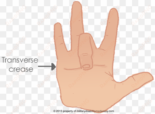 limitation of motion of the fingers - sign