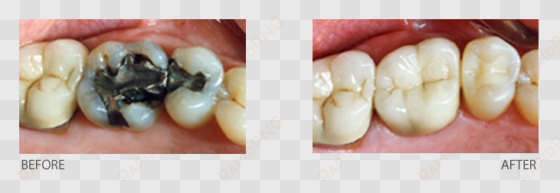 most often complete your crown in one visit with a - filling removal