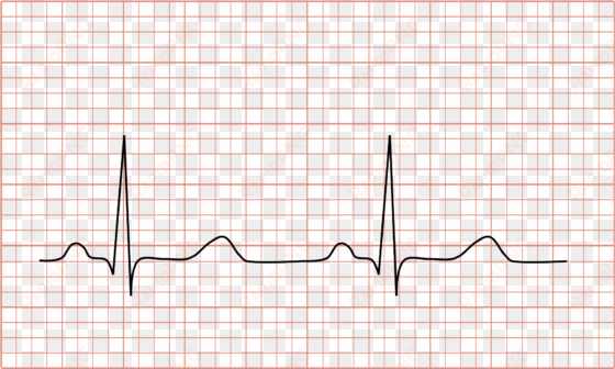 open - normal ecg