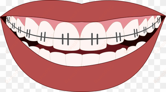 orthodontics, smile, teeth, dentist - mouth braces transparent background clipart