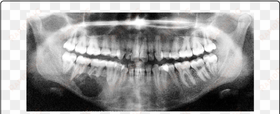 orthopantomogram unilocular radiolucency with scalloped - radiography