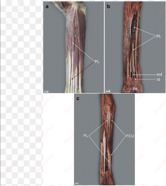 palmaris longus muscle