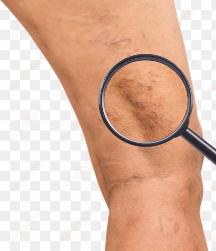 protruding, ropey or bulging veins - varicose veins