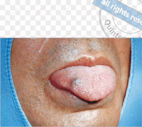 purple nodule located on the right dorsum of the tongue - purple lump on tongue