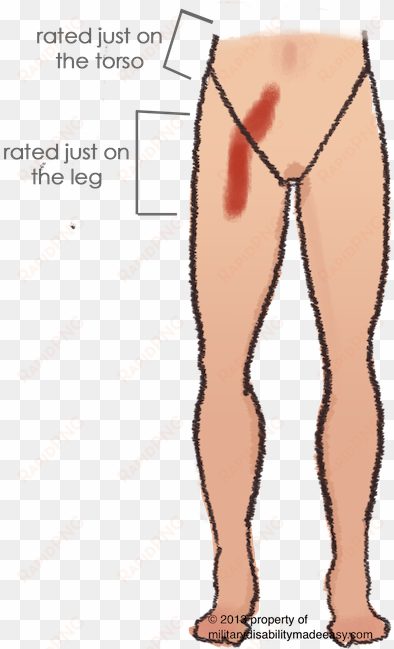 scar example 4 - kidney transplant scar on leg