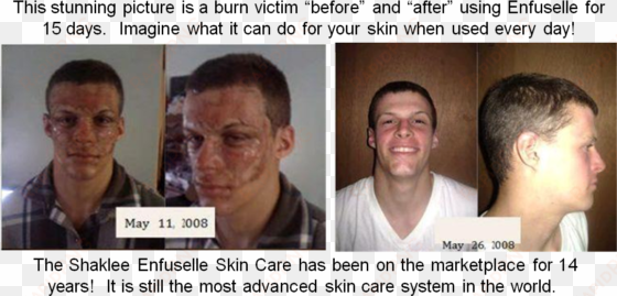 shaklee enfuselle - “ - burn skin care before and after