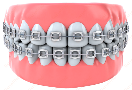 teeth - smoke braces color