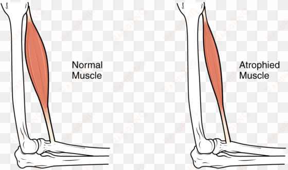 this image shows muscle atrophy - muscle atrophy