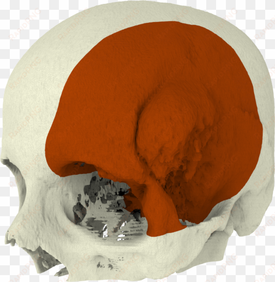 together with the surgeon our biomedical engineers - meningioma