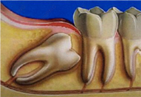 wisdom teeth - wisdom tooth